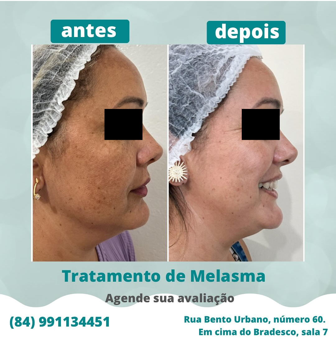 Rejuvenescimento & Clareamento